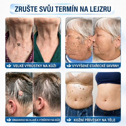 👩‍⚕️💯 Oficiální obchod | MURWON® 🌥️ Mikrojehličková náplast pro odstranění kožních nedokonalostí (Pro kožní výrůstky, drobné kožní útvary, bradavice, mateřská znaménka, stařecké skvrny a pigmentové nepravidelnosti.)💛