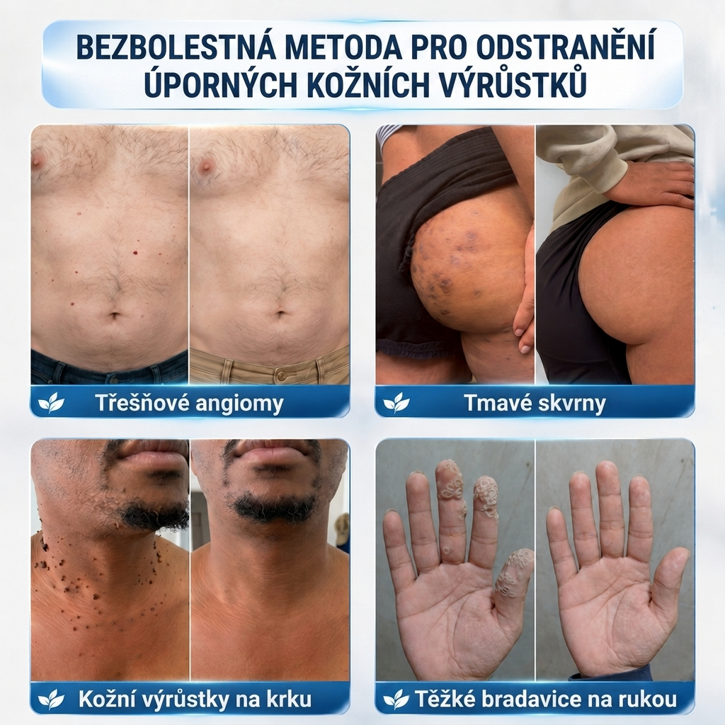 Oficiální přímý prodej | ✨MURWON® 🥦 Mikrojehličková náplast pro odstranění kožních nedokonalostí (Pro kožní výrůstky, drobné kožní útvary, bradavice, mateřská znaménka, stařecké skvrny a pigmentové nepravidelnosti.)