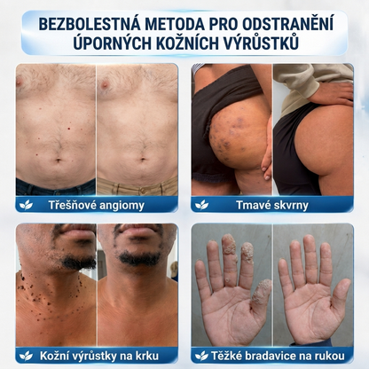 Oficiální přímý prodej | ✨MURWON® 🥦 Mikrojehličková náplast pro odstranění kožních nedokonalostí (Pro kožní výrůstky, drobné kožní útvary, bradavice, mateřská znaménka, stařecké skvrny a pigmentové nepravidelnosti.)